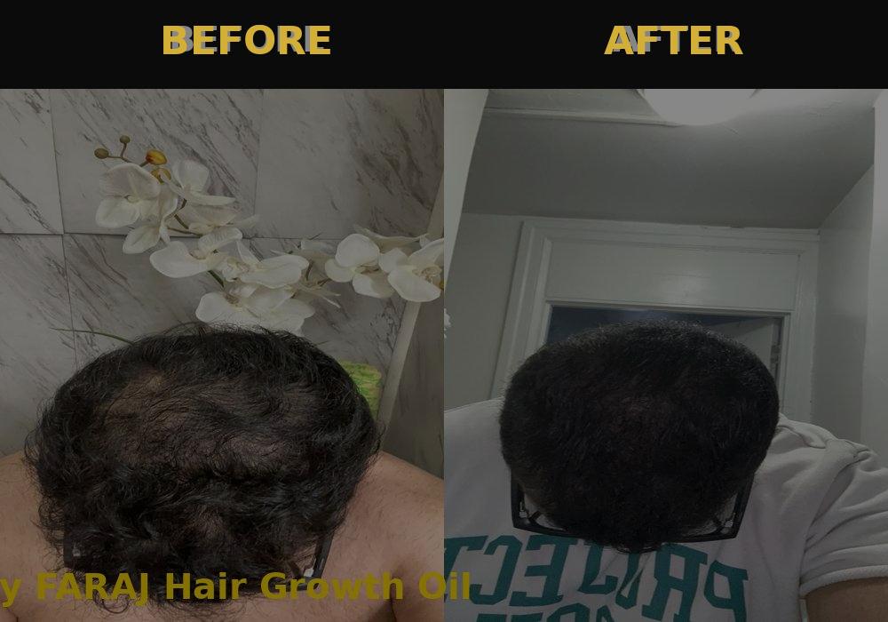 FARAJ Hair Growth Oil – For men & women. Helps fill patches, restore edges, and regrow hair. Nourishes the scalp and boosts circulation to support thicker, fuller, stronger growth with confidence.
